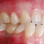 prohylasxe3